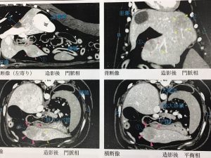 CT検査の画像：左上が針状異物の存在位置。その他は肝臓の腫瘤が赤矢頭、黄色の矢頭で示したところは嚢胞と考えられる。
