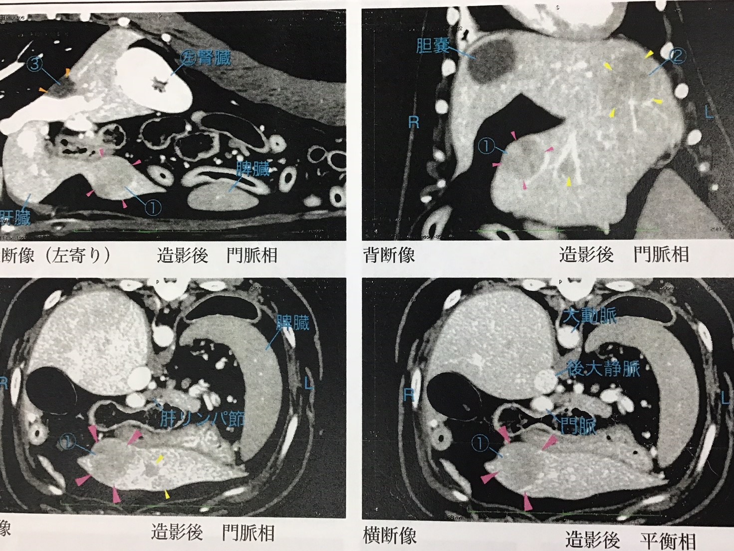 CT検査の画像:左上が針状異物の存在位置。その他は肝臓の腫瘤が赤矢頭、黄色の矢頭で示したところは嚢胞と考えられる。